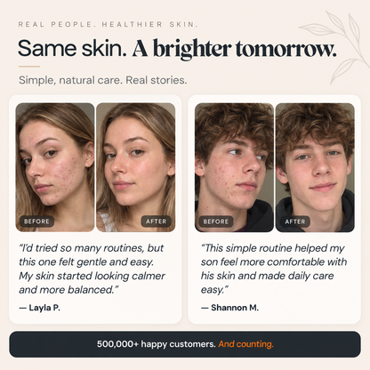 The Complete System for Acne-Prone Skin